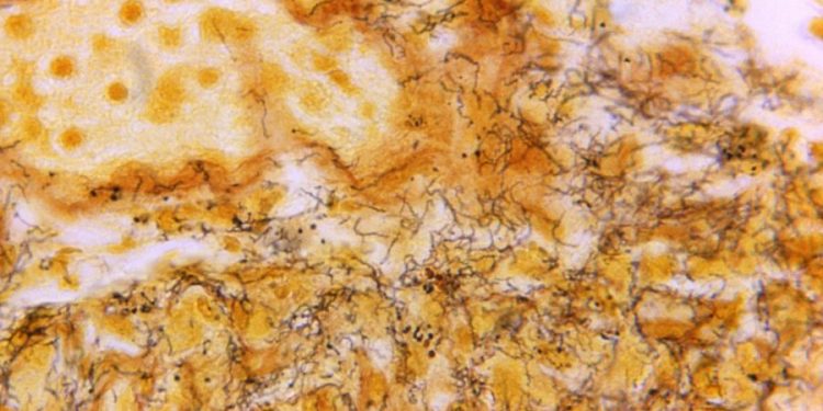 STI infection increase a ‘major concern’ for health officials: WHO