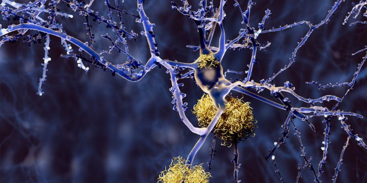 New Alzheimer’s study suggests genetic cause of specific form of disease