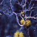 New Alzheimer’s study suggests genetic cause of specific form of disease