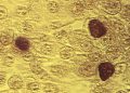 STD diagnoses jumped in recent years, especially among seniors