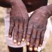 CDC warns of more severe mpox strain spreading in Central Africa