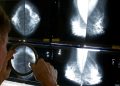 Breast cancer diagnoses ticking up among young women, Asian Americans: Research