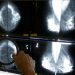 Breast cancer diagnoses ticking up among young women, Asian Americans: Research