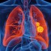 Lung cancer survival rate improves: Research