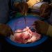 Surgeons implant new kind of engineered pig kidney