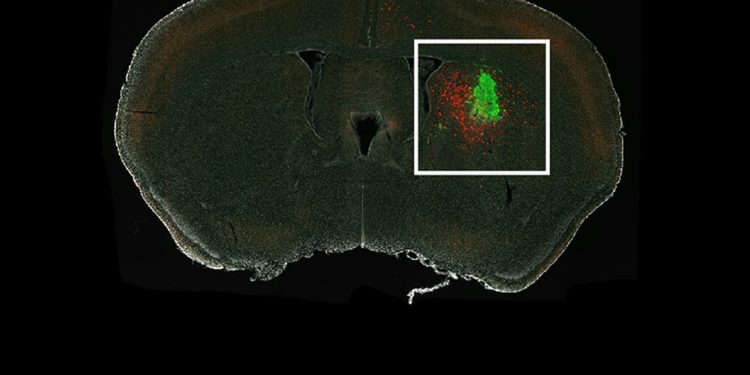 Why do gliomas tend to recur in the brain?