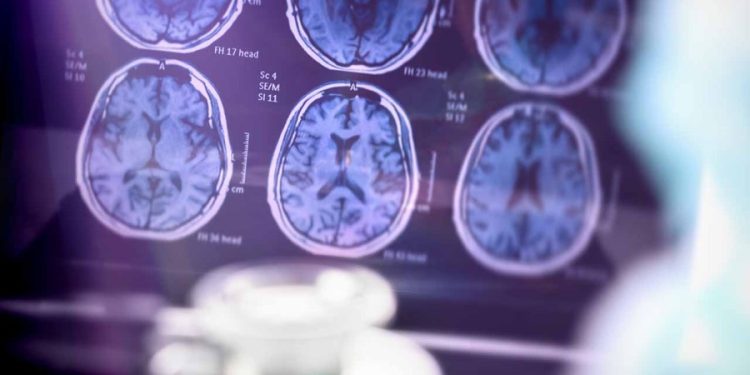 Dementia cases expected to double by 2060: Study