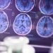 Dementia cases expected to double by 2060: Study