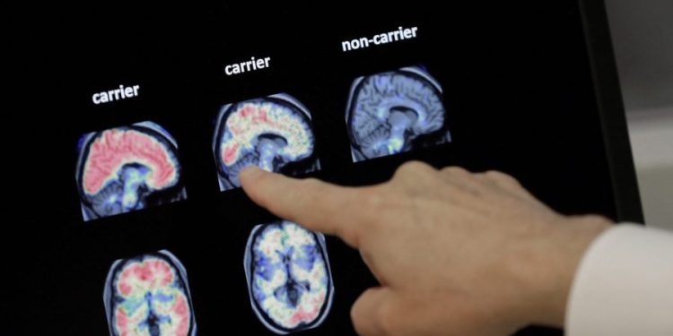 FDA clears first blood test to reliably predict Alzheimer’s disease