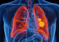 Air pollution may be raising risk of lung cancer in ‘never-smokers’: Study