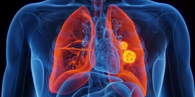 Air pollution may be raising risk of lung cancer in ‘never-smokers’: Study