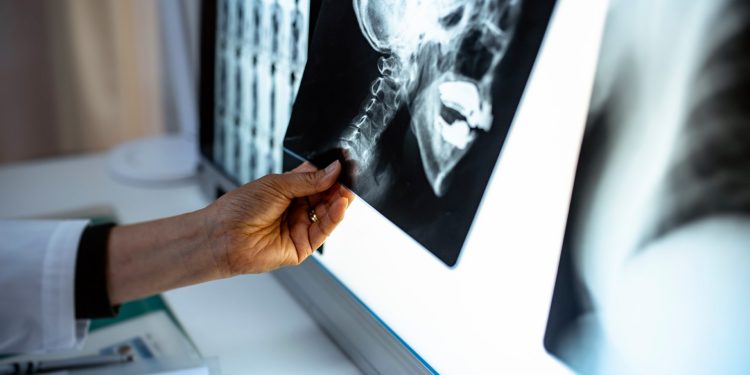 A setback to research that offered hope for fibrous dysplasia patients