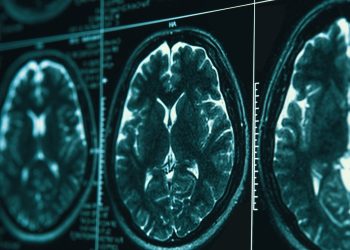 Making real gains in war on Alzheimer’s