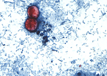 Doctor warns against ‘cyclospora skinny’ trend