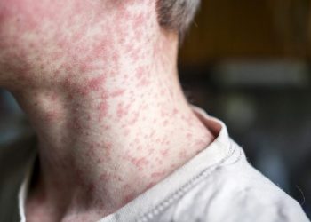 US exceeds measles cases in all of 2025 by July 2026