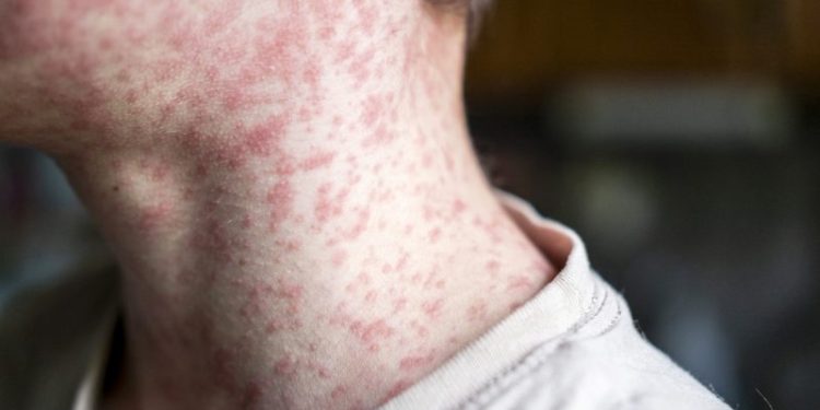 US exceeds measles cases in all of 2025 by July 2026