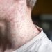 US exceeds measles cases in all of 2025 by July 2026