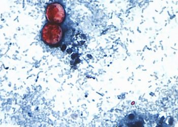Over 20K cyclosporiasis cases suspected in US as outbreak reportedly linked to 6 more states