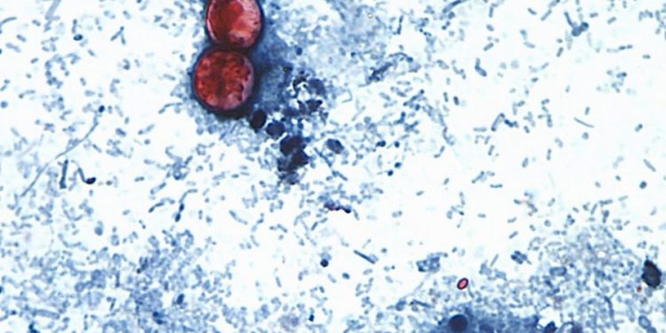 Over 20K cyclosporiasis cases suspected in US as outbreak reportedly linked to 6 more states