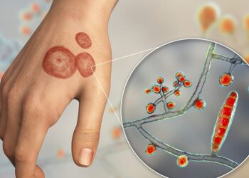 Drug-resistant ringworm fungus has spread to 29 countries: Study