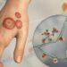 Drug-resistant ringworm fungus has spread to 29 countries: Study