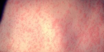 New York launches tracker as measles cases hit 57