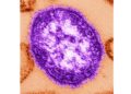 Pennsylvania reports 6th measles death