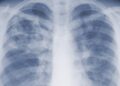 Pneumonic plague: What is it and how dangerous can it be?