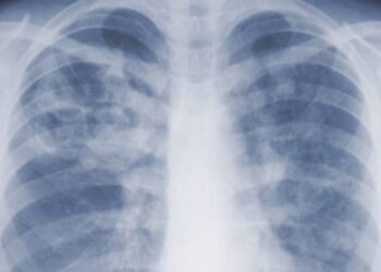 Pneumonic plague: What is it and how dangerous can it be?