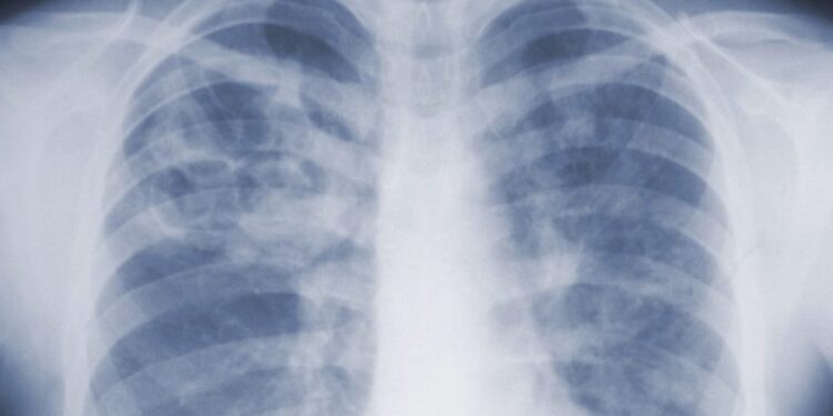 Pneumonic plague: What is it and how dangerous can it be?