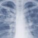 Pneumonic plague: What is it and how dangerous can it be?